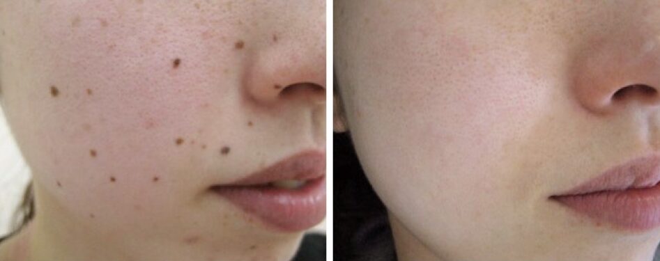 Laser-Mole-Removal-Pictures-kolambehospitalandskincare